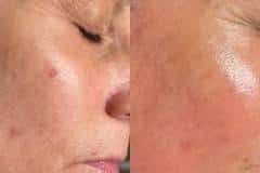 microneedling1