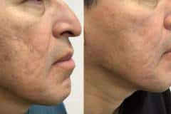 microneedling2