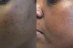 microneedling3
