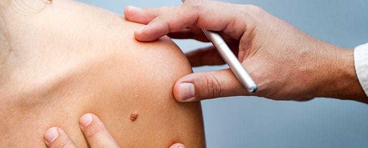 image of a dermatologist inspecting a mole on a person's shoulder for skin cancer