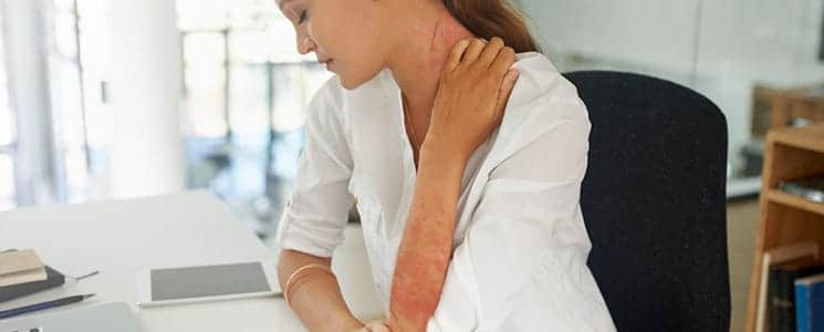 woman with psoriasis