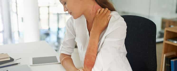 Psoriasis Treatment Dallas TX