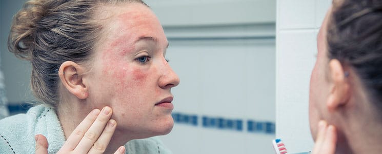 person with rosacea looking at face in the mirror