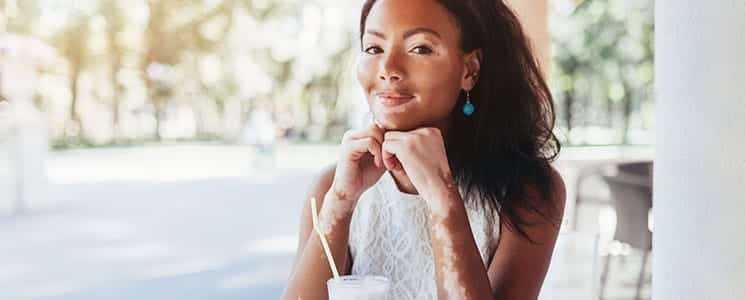 An image of a young girl with vitiligo smilling