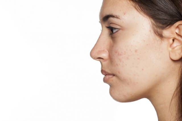 woman with cystic acne