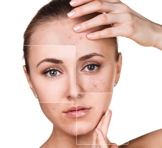 Acne Treatment Dallas, TX