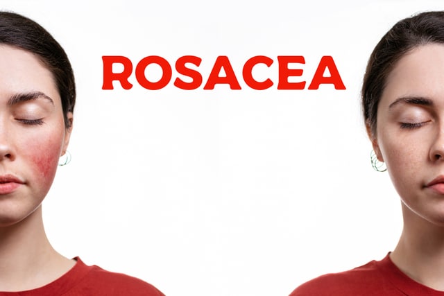 Before and after portrait of a young Caucasian woman with rosacea on her cheeks. 