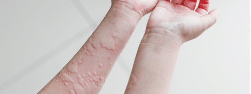 skin texture suffering severe rashes