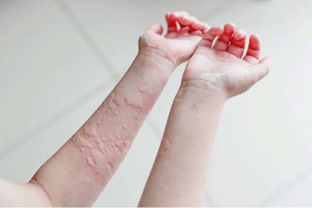 Five Signs You May Have Skin Allergies - Dallas Dermatology Center