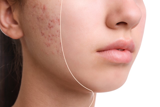 Teenage girl before and after acne treatment