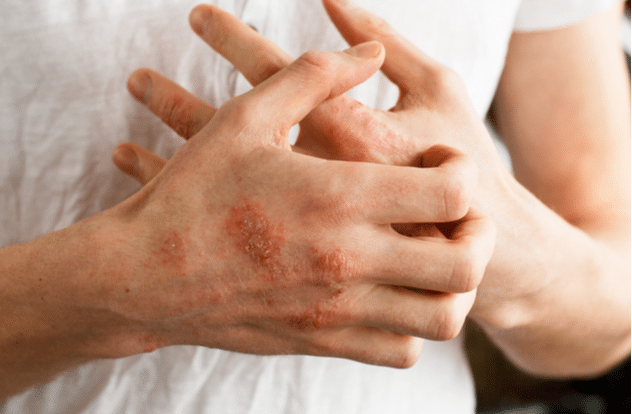 The problem with many people - eczema on hand.