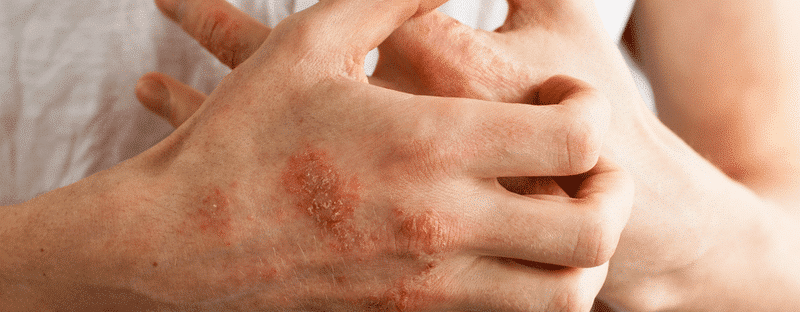 The problem with many people - eczema on hand.