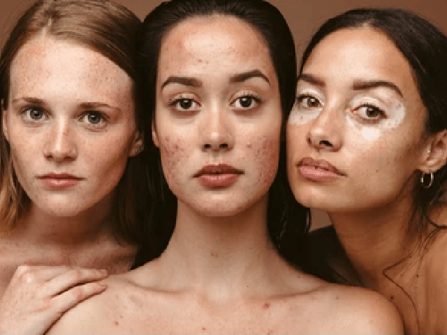 Young women having diverse skin disorders like freckles, acne and vitiligo.