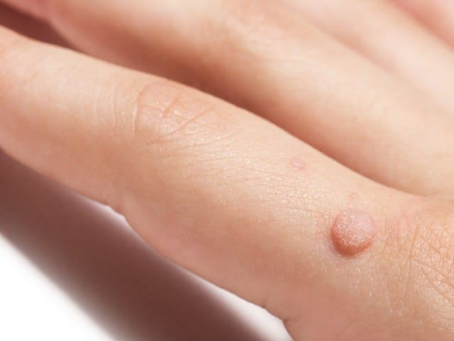 a flat wart commonly found on the hand of children and adults
