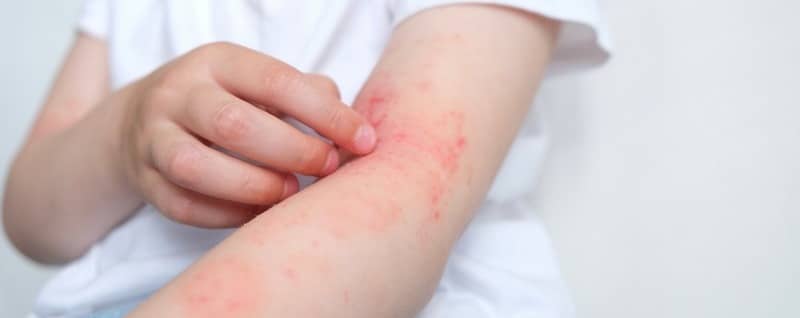 Skin allergies