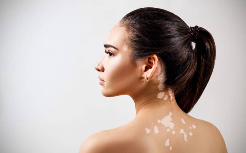 A profile shot of a woman with vitiligo on her back