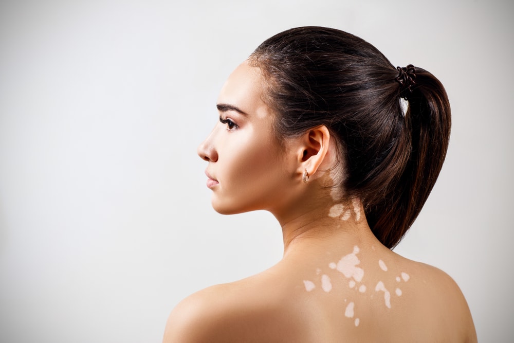 A profile shot of a woman with vitiligo on her back