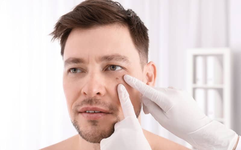 A dermatologist examining a mole on a man’s cheek before Mohs surgery in Dallas