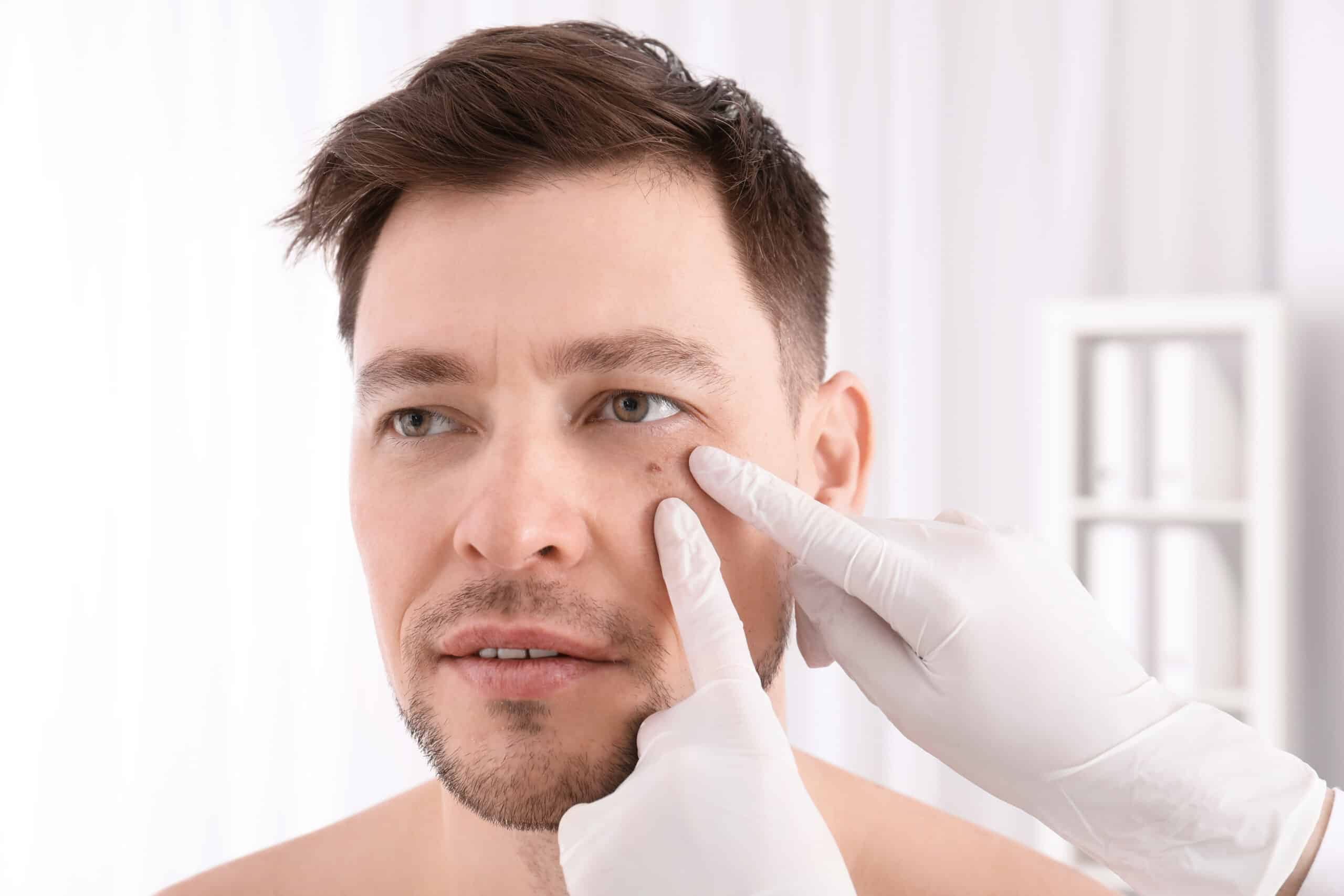 A dermatologist examining a mole on a man’s cheek before Mohs surgery in Dallas