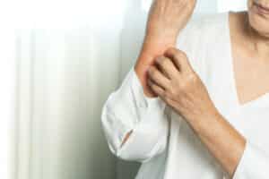 A close-up shot of a woman with a skin infection scratching her arm