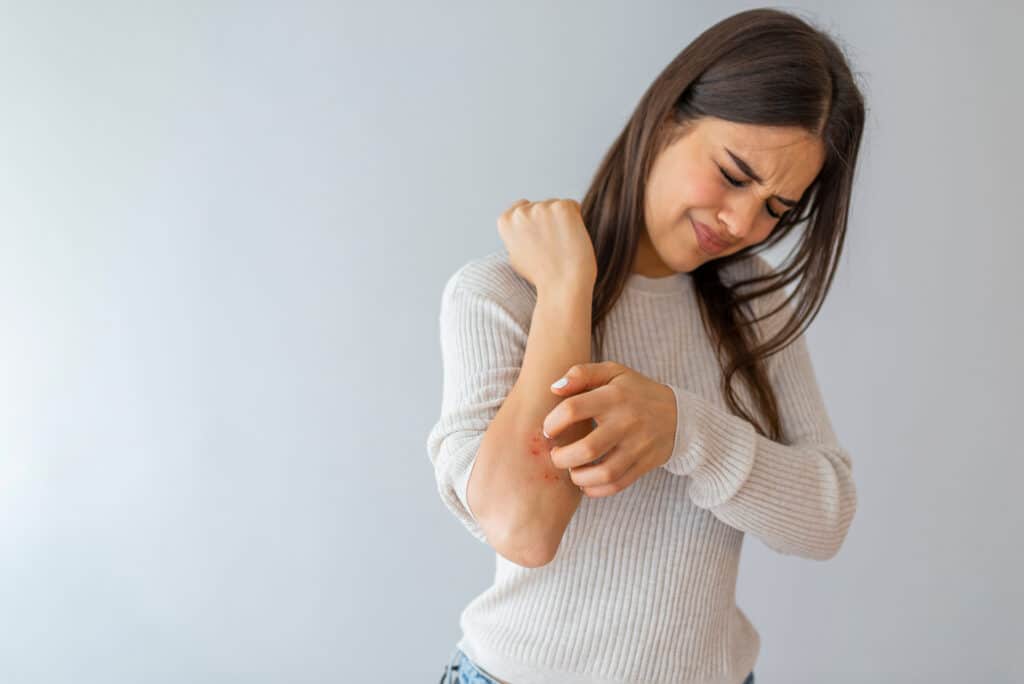 A woman with eczema scratching her arm