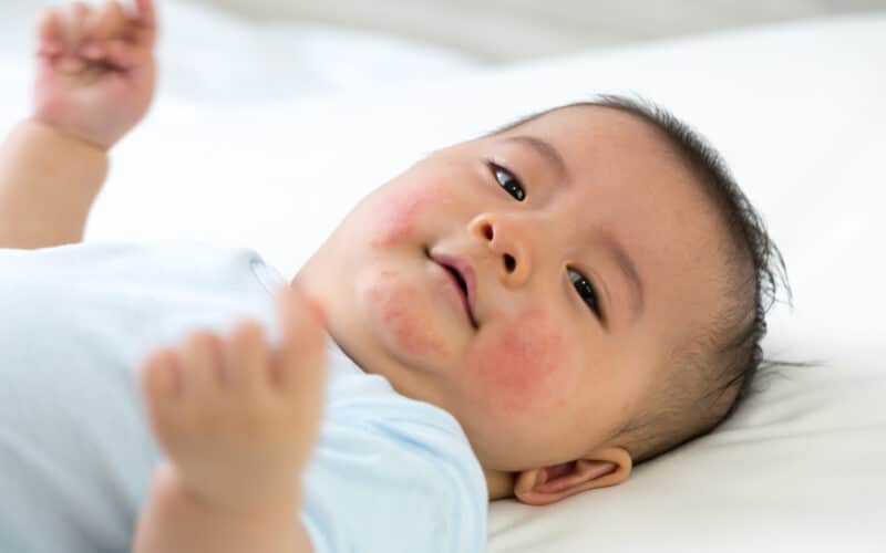 Baby has an allergic reaction to the face, Skin rashes in babies concept