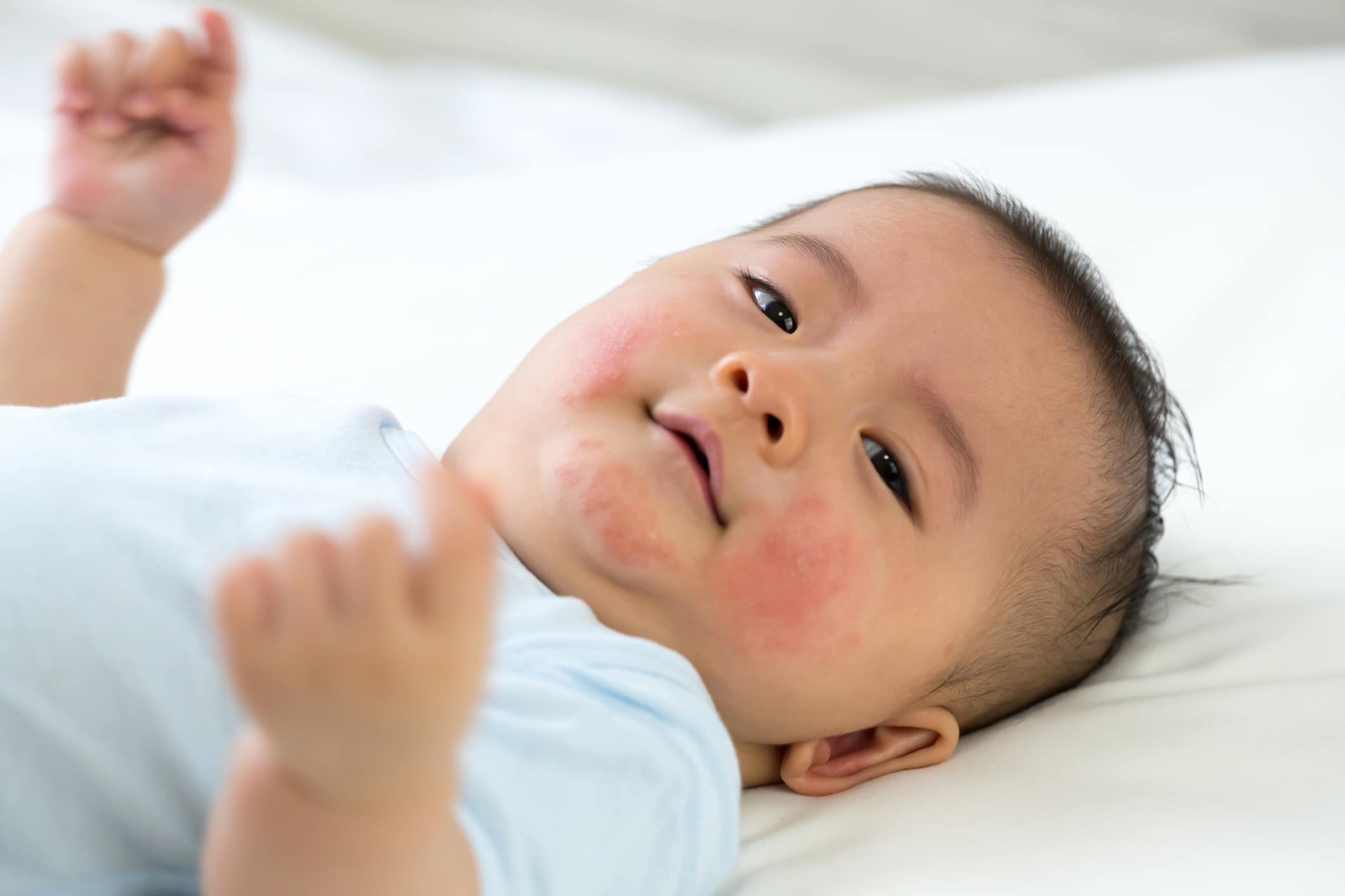 Baby has an allergic reaction to the face, Skin rashes in babies concept