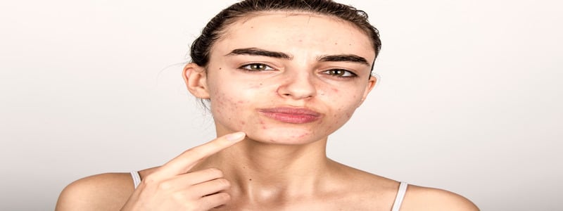 A woman pointing to acne on her skin
