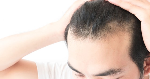 A close-up shot of a man experiencing hair shedding at the hair line