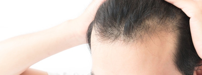 A close-up shot of a man experiencing hair shedding at the hair line
